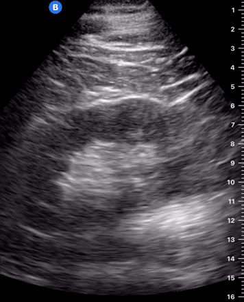 Renal — Ultra Sono